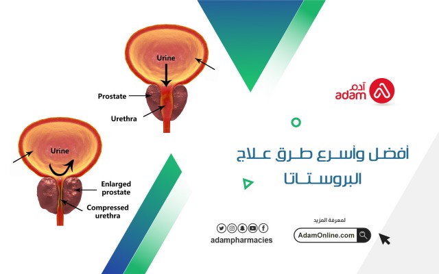 أفضل وأسرع طرق علاج البروستاتا
